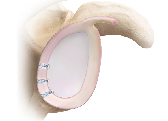 Arthrex - SwiveLock® Suture Anchors: The Most Trusted and